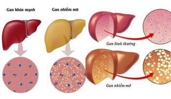 Bệnh gan nhiễm mỡ: Triệu chứng và cách phòng ngừa