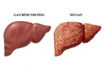 Xơ gan: Nguyên nhân, triệu chứng và cách điều trị