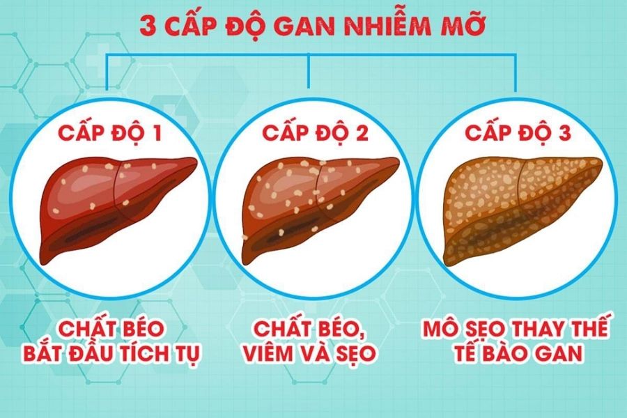 Các cấp độ gan nhiễm mỡ và triệu chứng