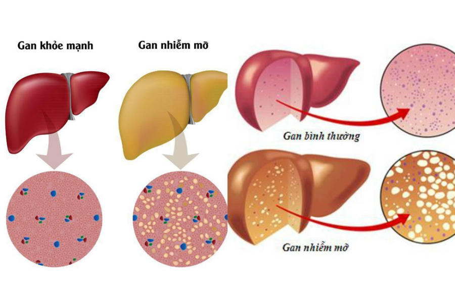 Gan nhiễm mỡ