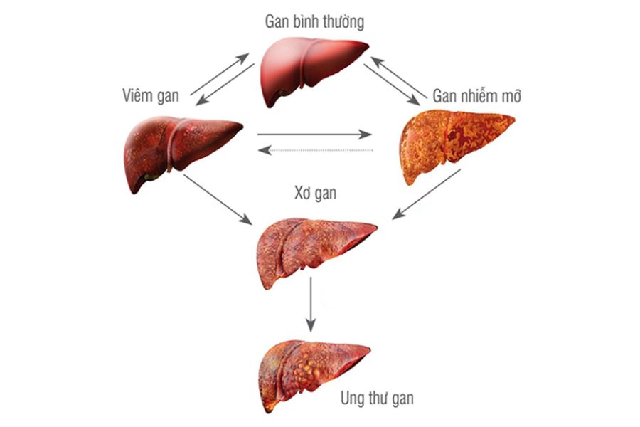 biến chứng xơ gan