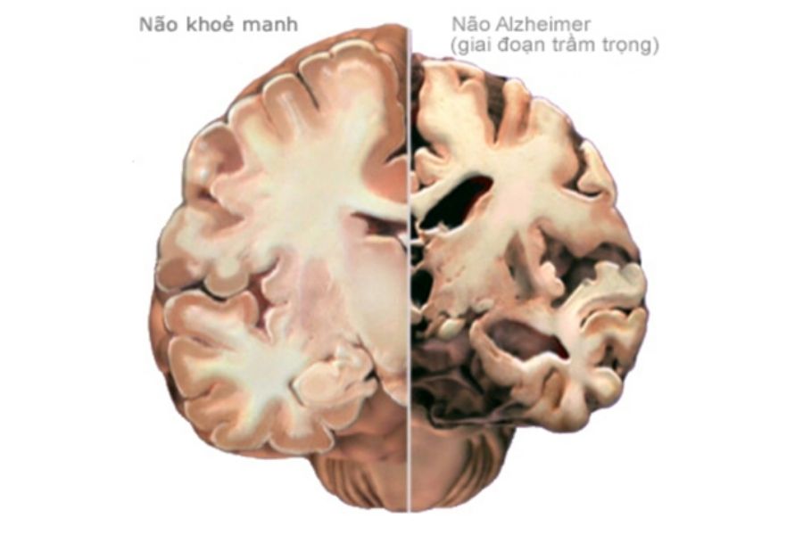 Chẩn đoán bệnh Alzheimer