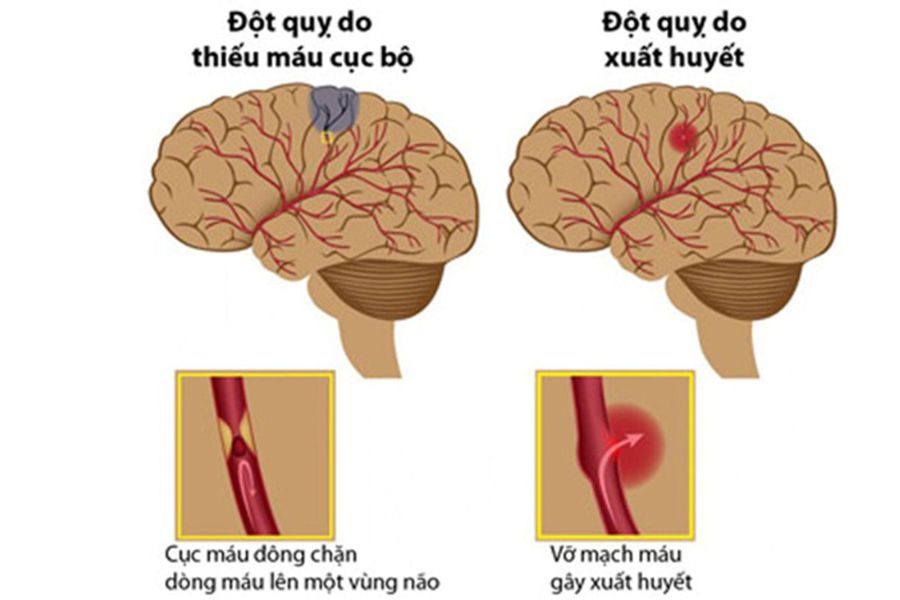 Các thể đột quỵ 